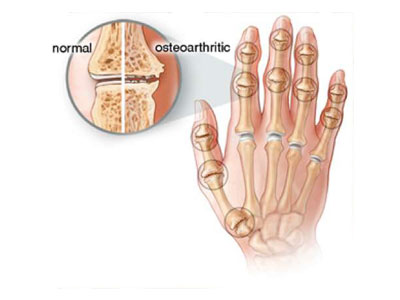 Başparmak Taban Eklemi Osteoartriti