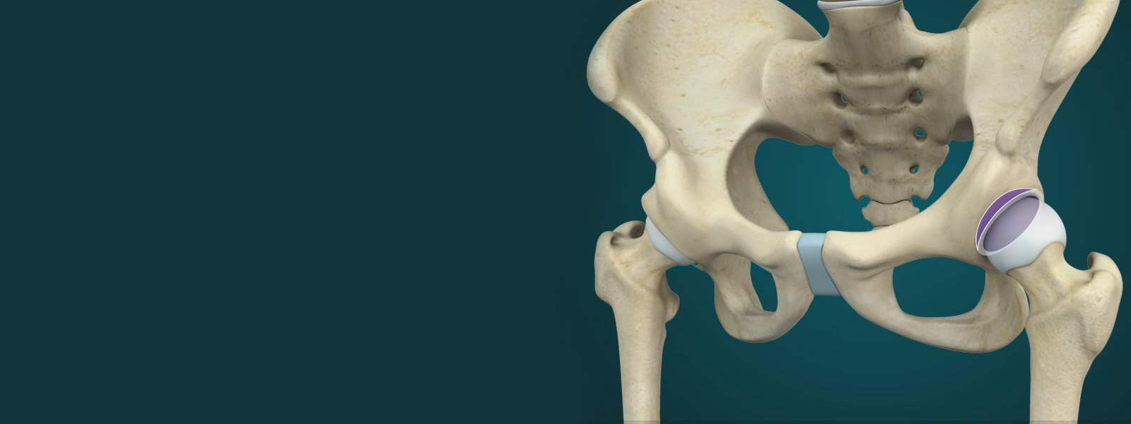 Kalça Osteotomisi