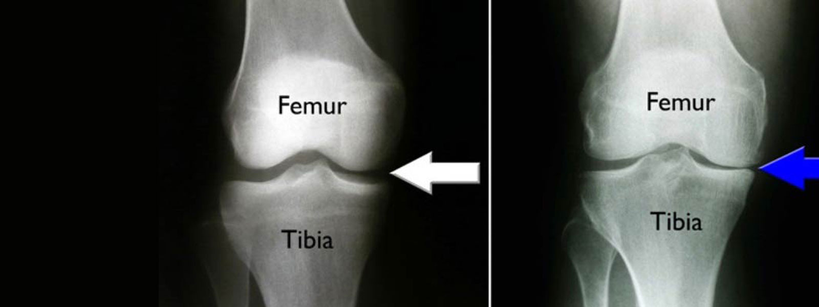 Yüksek Tibial Osteotomi